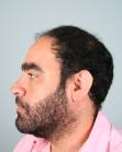 Before Hair Transplant&nbsp;2 Sessions (Areas)